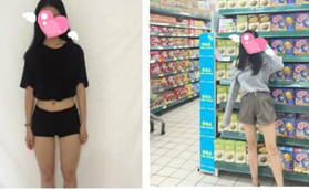 沖著武漢仁愛(ài)時(shí)光包濤口碑去做的大腿吸脂，成功抽脂1500ml