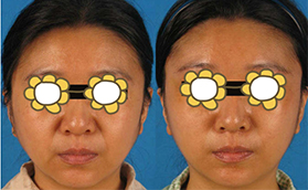 畢洪森內(nèi)窺鏡除皺多少錢？奉上北醫(yī)三院除皺案例及價(jià)格表