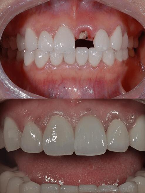 蘭州皓亞口腔種植牙怎么樣？ 韓國奧齒泰TS種植系統(tǒng)好嗎？