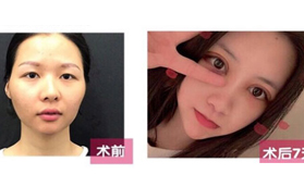 幾千和幾萬的雙眼皮有什么區(qū)別?我在惠州伊麗莎白花了4800元