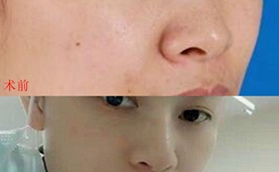 青島博士高鍔院長給我做玻尿酸隆鼻，效果我很滿意！