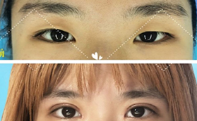 梁偉中做雙眼皮怎么樣？被北京煤醫(yī)一萬(wàn)多眼綜合案例種草