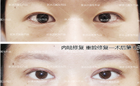 北京張冰潔修復(fù)雙眼皮怎么樣？案例及價(jià)格表看技術(shù)亮點(diǎn)
