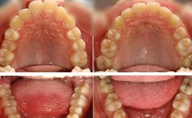 我找青島牙博士王蕓做牙齒矯正，大家覺得效果怎么樣？