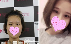 武漢美麗力量馬行給我做的7毫米全切雙眼皮改變還蠻大的