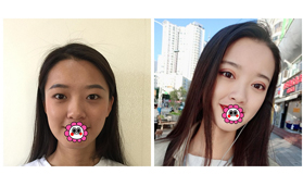 昆明華美美萊李韜技術(shù)如何？分享急速納米雙眼皮案例參考