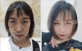 同樣是雙眼皮，怪不得找昆明美伊萊周誠做的評價很高