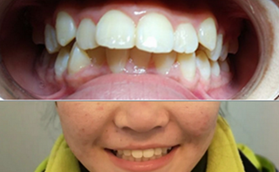 我在青島全好口腔做牙齒矯正真實感受，附前后對比照片