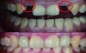牙齒缺失在許昌口腔五一路門診做完種植牙后他笑的很開心