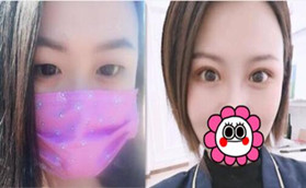 快看我在許昌麗娜整形醫(yī)院割的6.5mm雙眼皮效果還不錯吧！