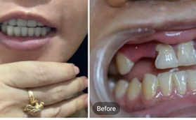 真實(shí)案例告訴你，為什么選擇在南京金鉑利做種植牙