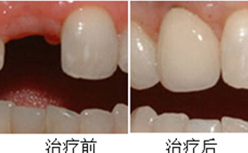 我是在北京維樂口腔中關(guān)村店做了單顆韓國(guó)奧齒泰種植牙