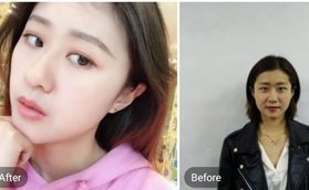 南京韓辰醫(yī)院做玻尿酸隆鼻后悔死了，前后對比圖來看效果