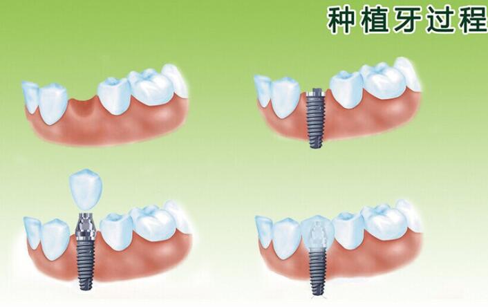 洛陽(yáng)友好口腔種植效果怎么樣？?jī)r(jià)格貴不？有終身質(zhì)保嗎？