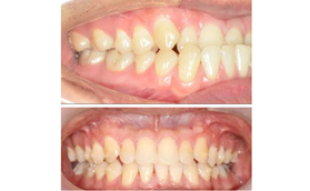 28歲才整牙的心路歷程,戴時代天使隱形牙套1年多矯正地包天