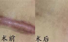 長沙卓而美醫(yī)療美容醫(yī)院疤痕修復對比案例