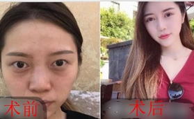 做鼻綜合有沒(méi)有后遺癥？看我在南京瑧顏?zhàn)龅男Ч趺礃?></div>
                      </a>
                    </li>
                                                          </ul>
                </td>
            </tr>
          </tbody>
        </table>
      </div>
      <div   id=