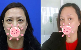 外切去眼袋后的疤痕無法愈合?并不會，這有真人案例參考哦