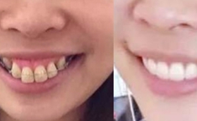 牙齒矯正會(huì)改變臉型嗎？我在南京牙院長(zhǎng)做完很滿意