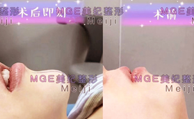 從三組常州美紀硅膠墊下巴真人案例看，術(shù)后效果到底咋樣