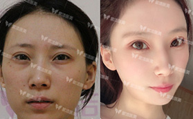 北京紫潔祛眼袋多少錢?找王春燕做UM無(wú)痕不開(kāi)刀去眼袋花2w多