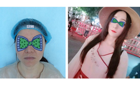 終于在33歲做了四代熱瑪吉全臉除皺，大家來看效果咋樣