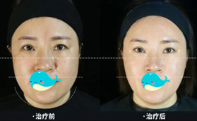 熱瑪吉全臉除皺到底疼不疼？說(shuō)實(shí)話疼，但效果也是真的好