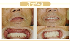 沈陽完佩口腔61歲大爺做完全口種植牙后的真實(shí)感受分享