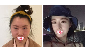 實(shí)例對(duì)比看蘇州美萊做立秀膨體+耳軟骨墊鼻尖效果好嗎