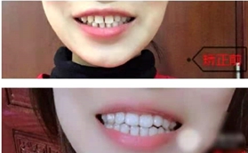 牙齒稀疏怎么矯正？看我在南京康貝佳做隱形矯正前后對比