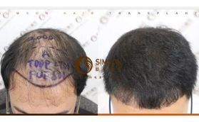 三級脫發(fā)在蘇州新生植發(fā)2000單位毛囊后改善禿頭