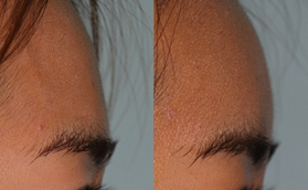 韓國愛護整形醫(yī)院額頭填充前后對比照