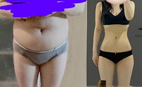 花5萬在韓國做腰腹環(huán)吸真值！3個月水桶腰變成超細螞蟻腰