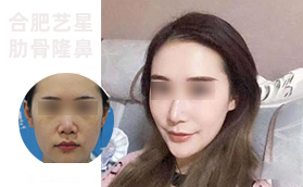 合肥藝星肋骨隆鼻