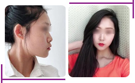 濟(jì)南美蓮醫(yī)療美容醫(yī)院膨體隆鼻對(duì)比