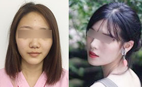 我在合肥瑤海壹加壹找王大勇院長做鼻綜合