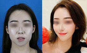 合肥韓美注射瘦臉