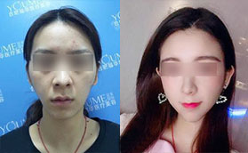 在合肥福華做自體脂肪填充+鼻多項(xiàng)（假體隆鼻+耳軟骨鼻尖）