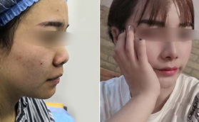 濟南鵬愛鼻部多項-耳軟骨隆鼻對比