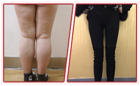 濟(jì)南美蓮醫(yī)療美容門(mén)診部脂黃金體雕術(shù)對(duì)比